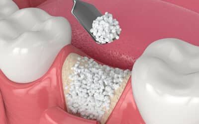 What is Bone Grafting?