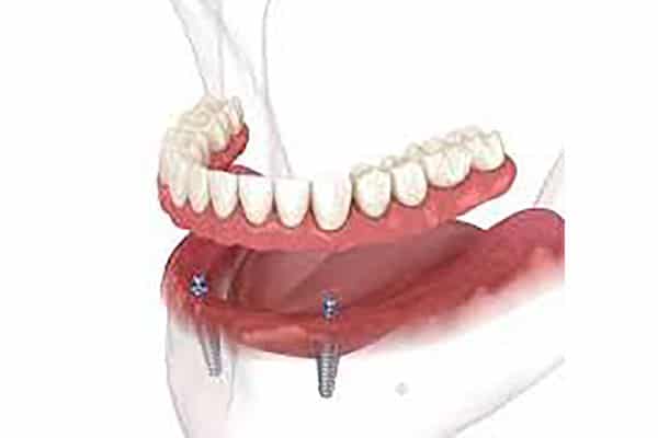 Overdenture
