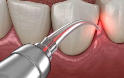 Exploring Gum Therapy: Restoring Gum Health