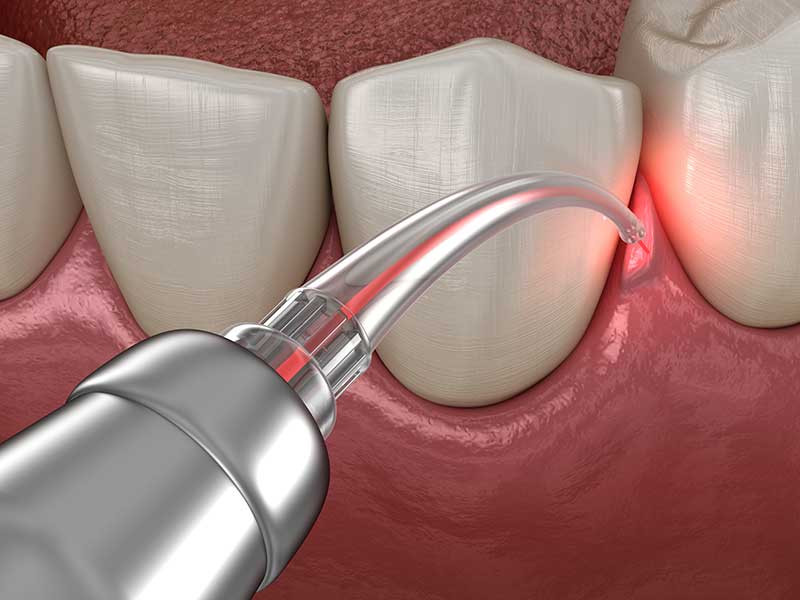 Exploring Gum Therapy