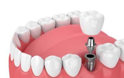 Understanding Dental Implants: A Comprehensive Guide