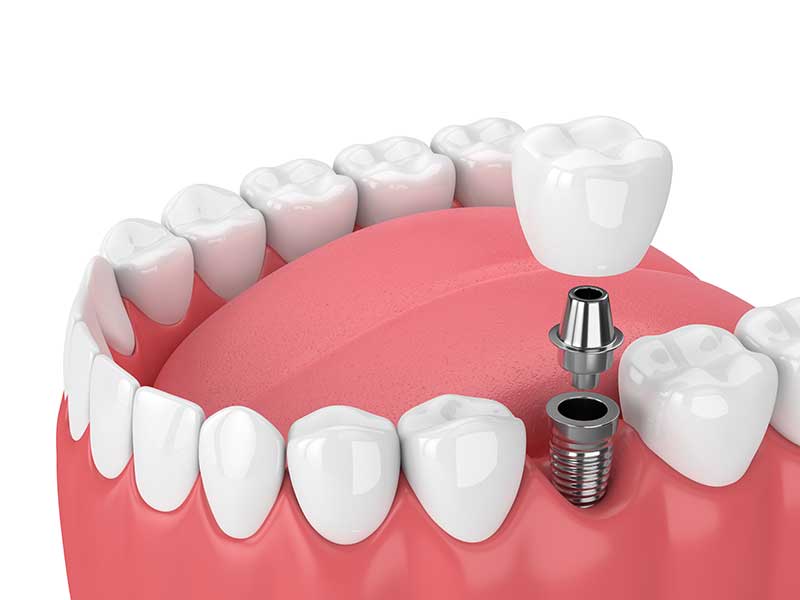Understanding Dental Implants