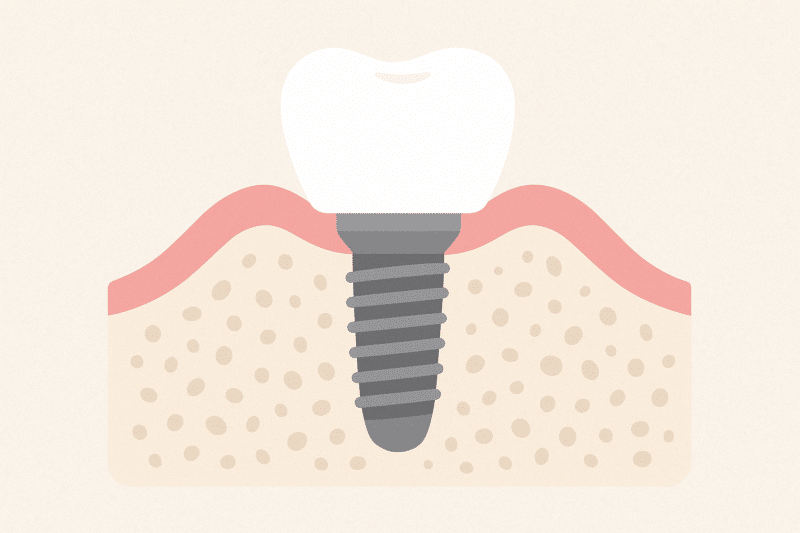 bone graft for implant